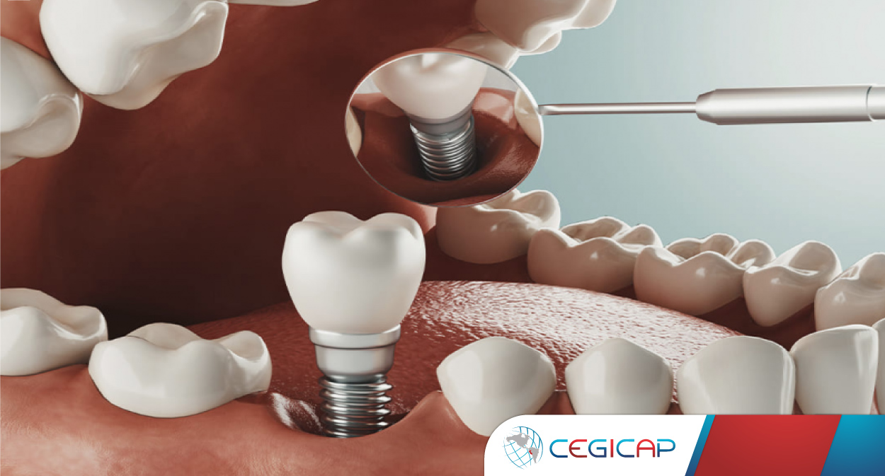 IMPLANTOLOGÍA ORAL